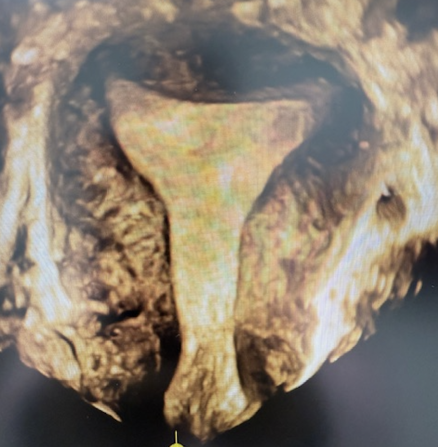 Pelvic Ultrasound Scan